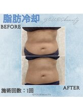 ユアーズ ビューティー(YOURS beauty)/脂肪冷却