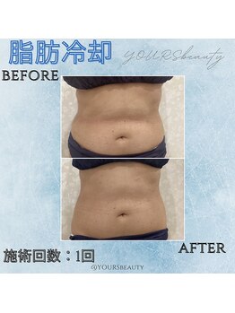 ユアーズ ビューティー(YOURS beauty)/脂肪冷却