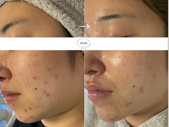 スワン 大阪南堀江(swan)/お肌の赤み、ニキビにお悩みの方