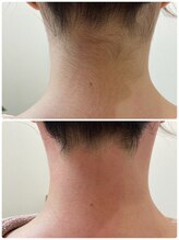 ヒスイ バイ アメイジング(Hisui by AMAZING)/うなじ/脱毛/シェービング/WAX