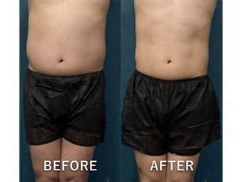 ブランシュムーニー(BRANCHE MOONY)/セル脂肪分解マシンと脂肪冷却