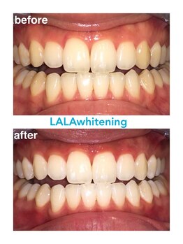 ララホワイトニング/Before&After強力ホワイトニング