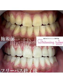 ホワイトニングサロン 福岡博多店/ホワイトニング
