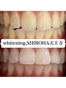 シロハ(SHIROHA)/セルフホワイトニング/天王寺
