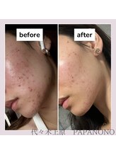 ビューティーラボ パパノノ(BEAUTY LABO PAPA NONO)/ニキビでお悩みの方にもオススメ