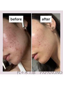ビューティーラボ パパノノ(BEAUTY LABO PAPA NONO)/ニキビでお悩みの方にもオススメ