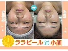 ウルオイ 海老名(URUoi)の雰囲気(人気No.1☆ 韓国ララピール×小顔矯正 1回のビフォー・アフター)