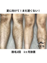 イエス 佐賀店(YES)/足脱毛ビフォーアフター