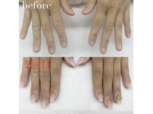 【美爪矯正】深爪、爪の凹凸、2枚爪、様々なお爪の悩みを改善