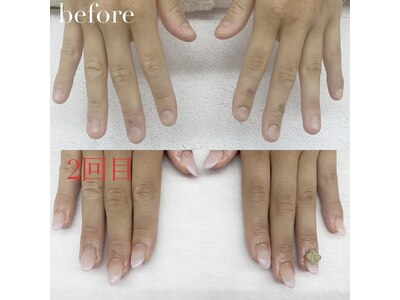 【美爪矯正】深爪、爪の凹凸、2枚爪、様々なお爪の悩みを改善