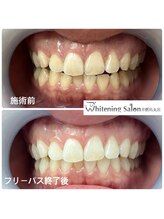 ホワイトニングサロン 京都烏丸店/ホワイトニング施術例