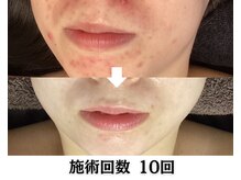 バース(Birth...)/ハーブピーリング/ニキビケア