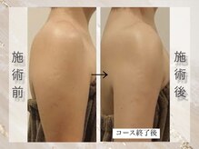 ミライ 福岡春日店(mirai)/二の腕集中 VenusDIVA