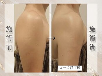 ミライ 福岡春日店(mirai)/二の腕集中 VenusDIVA