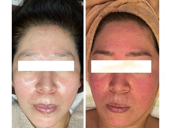 白雲木/酒さ、超敏感肌の方におすすめ