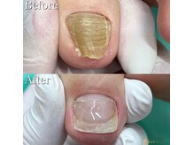 巻き爪補正店 豊田店/【分厚い爪／変形爪再生補正】