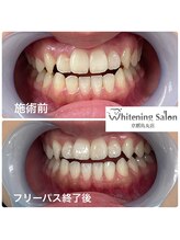 ホワイトニングサロン 京都烏丸店/ホワイトニング施術例