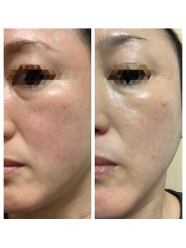 ノレーヴ(NOS REVES)/たるみ、ほうれい線