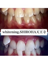 シロハ(SHIROHA)/セルフホワイトニング/天王寺