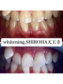 シロハ(SHIROHA)/セルフホワイトニング/天王寺