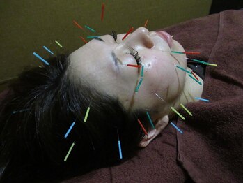 美容整体サロン 癒人の写真/【美容鍼定額制がオススメ★】シワやたるみが気になる方へ…!理想の小顔を目指しましょう!