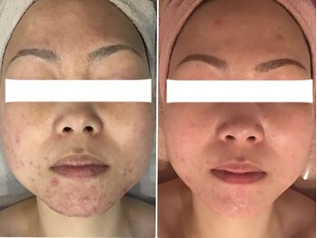 エステティックサロン フェアリー(ESTHETIC SALON FAIRLY)/VOSサロンケア/before after
