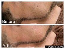 ビダン(BIDAN)/デザインヒゲ脱毛　BeforeAfter