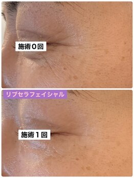 プリュネル(Prunelle)/プラズマシャワー