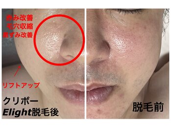 クリスタルボウ(Crystal BEAU)/メンズヒゲ脱毛1回のみ