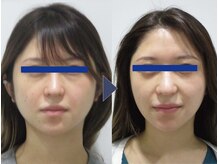 美デザイン 福岡天神本店(美.design)/☆小顔矯正+頭蓋骨矯正+首肩矯正