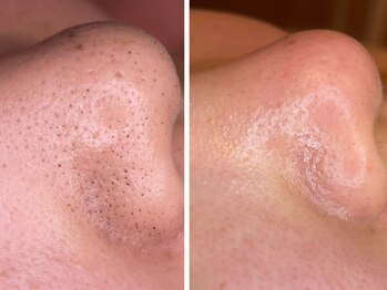 ヒメミ(Himemi)/毛穴エクストラクションtete式