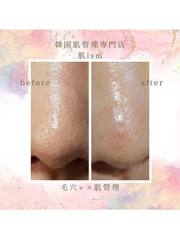 肌イズム 守谷店(肌ism)/【before&after】毛穴レス/撲滅