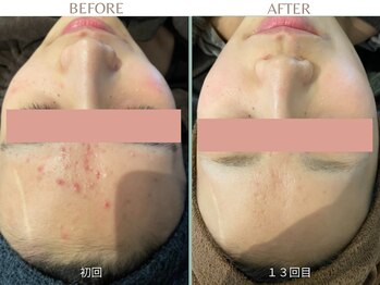 エミルカ 日の出平井店(EMILUCA)/おでこのニキビが気になる方