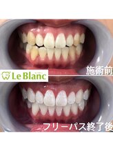 ルブラン 奈良店(Le Blanc)/歯の色って見てますか？