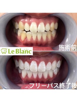 ルブラン 奈良店(Le Blanc)/歯の色って見てますか？