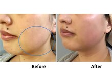 ビオモ 銀座(BIOMO)/気になる頬肉もスッキリ！