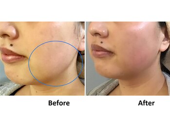 ビオモ 銀座(BIOMO)/気になる頬肉もスッキリ！