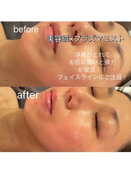 ディア(Deer)/ビフォー・アフター　美容鍼