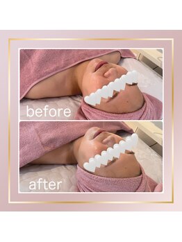 ベルメール(Bellemer)/アンストレス施術のお客様♪