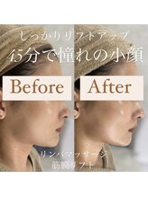 クリニカルホワイトケア 和泉府中店(クリニカルWHITEケア)/小顔リフトアップ◎(1回)