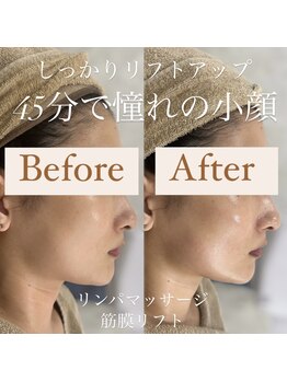 クリニカルホワイトケア 和泉府中店(クリニカルWHITEケア)/小顔リフトアップ◎(1回)