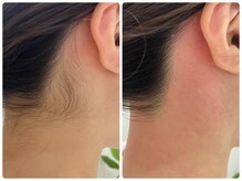 ヒスイ バイ アメイジング(Hisui by AMAZING)/うなじ/脱毛/シェービング/WAX