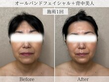 フラリ 西葛西(Hulali)/【40代】オールハンド小顔＋背中