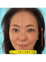 ネクスフィット(Nexfit)/小顔矯正フェイスリフトの効果