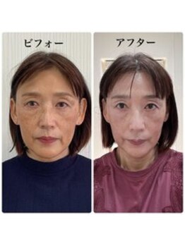 シェノン(CHAINON)/小顔矯正/リフトアップ/松阪市