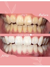 エクシアホワイトニング 札幌中島公園店/ホワイトニングビフォーアフター