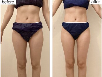 ルシエル ハカタ(Luciel HAKATA)の写真/【全身痩身】肩こりや首コリ、むくみや便秘など不調改善＆全身を温めながら痩身の組み合わせ。