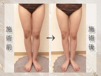 ミライ 福岡春日店(mirai)/美脚目指して集中ケア VenusDIVA