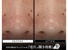 メディケア 新宿/ENVIRON フルコース【毛穴汚れ】