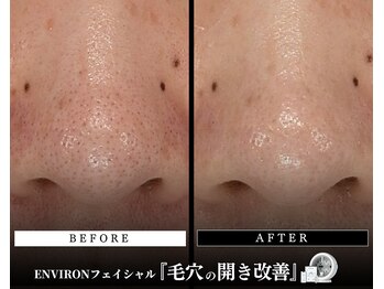 メディケア 新宿/ENVIRON フルコース【毛穴汚れ】